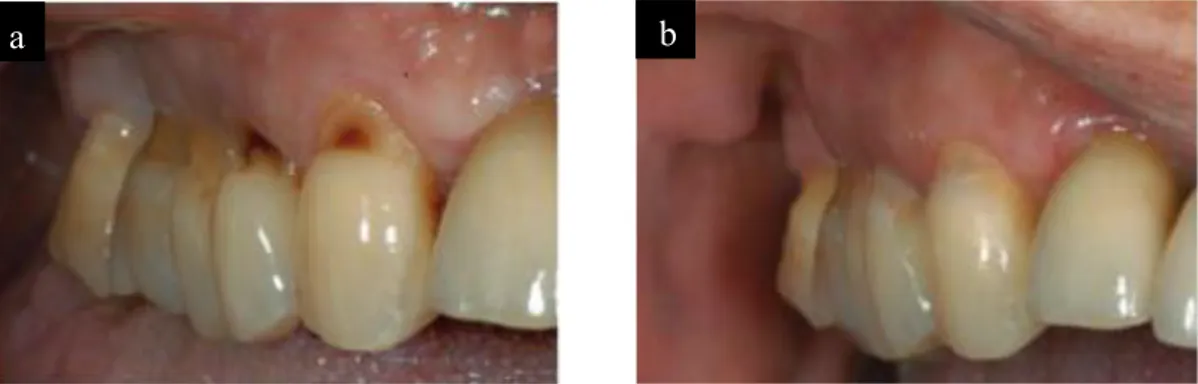 Figure 7 : traitement de caries radiculaires  (44)