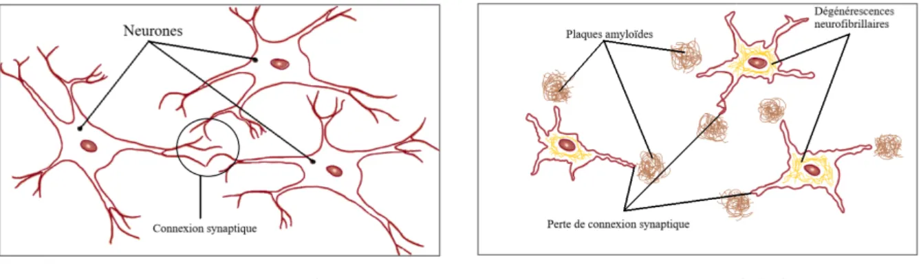 Fig1 : Illustration simplifiée d’un cerveau normal (A) et d’un cerveau présentant la  maladie d’Alzheimer (B) d’après l’article  16