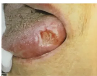 Fig 16: Hématome traumatique de la  lèvre inférieure  105   