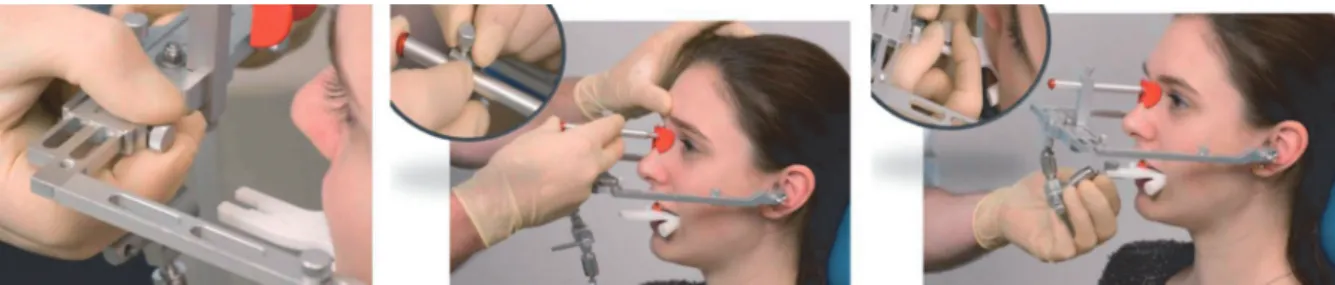 Figure 11: utilisation d'un arc facial 