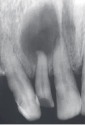 Figure 4. Radiographie rétroalvéolaire d'un kyste radiculaire (40) 