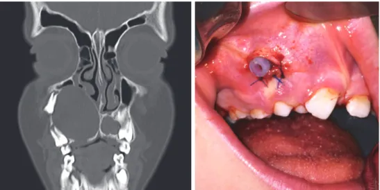 Figure 6. Cas de kératokyste odontogénique traité par marsupialisation  avec a) coupe frontale du scanner et b) vue clinique après mise en place 