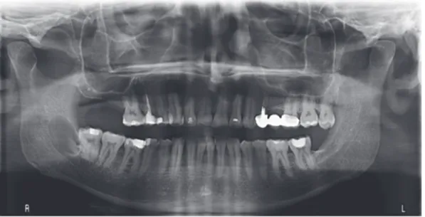 Figure 8. Cas n°1, Orthopantomographie, lésion radioclaire de la branche montante droite 