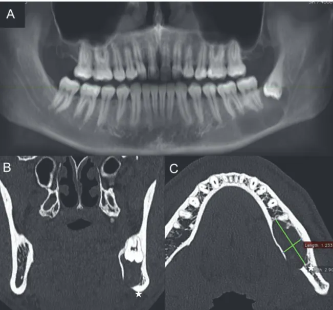 Figure 10. Cas n°2, Orthopantomographie mettant en évidence une lésion ostéolytique  en rapport avec la dent 38 (A)