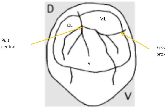 Figure 2 - Deuxième prémolaire mandibulaire 45 V ML DL Puit central  Fossette  proximale 