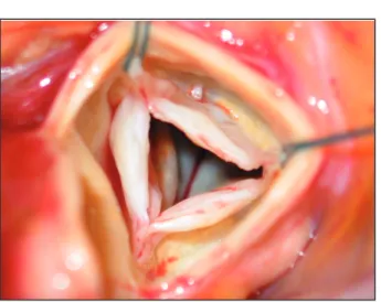 Figure 2. Valvule aortique épaissie par un tissu myxoïde modérément cellu- cellu-laire