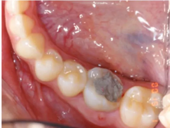 Figure 2. Vue latérale gauche, site receveur après avulsion et curetage (21) 