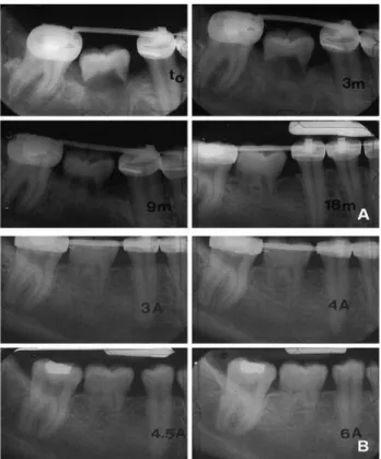 Figure 18. Édification radiculaire du germe de 48 transplanté en situation de 46 (68) 