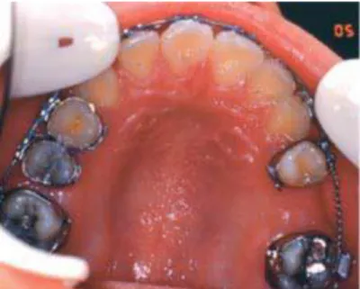 Figure 19. Phase orthodontique préchirurgicale de réouverture d’espace au niveau du site receveur