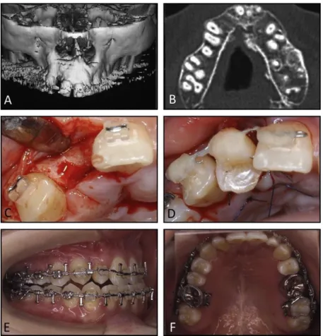 Figure 24. A et B : Reconstitution tomodensitométrique avant l’autotransplantation;                                