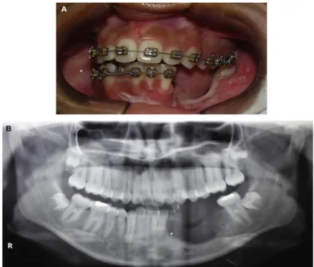Figure 27.Défaut osseux mandibulaire après résection en bloc de la lésion s’étendant de la canine  mandibulaire gauche à la première molaire mandibulaire gauche