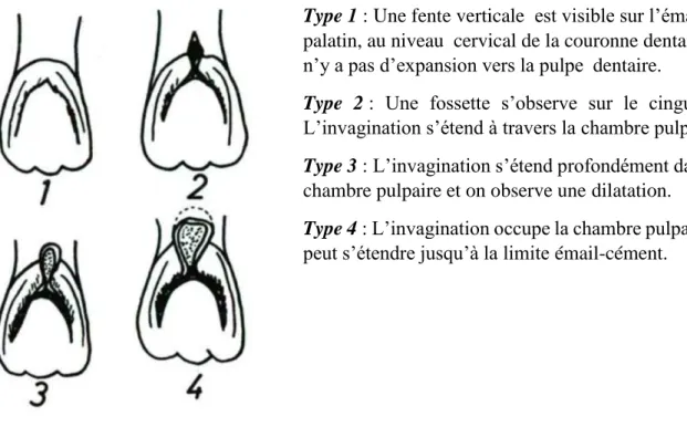 Figure 2 : Représentation schématique des quatre classes de dens in dente par Hallet (1953) (8) 