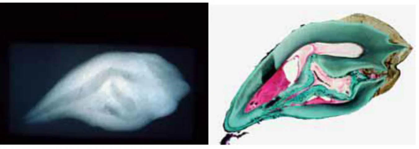 Figure 6 : Dens invaginatus de type III selon Oehlers (1957) avec une invagination se terminant  latéralement dans le parodonte et une morphologie dentaire fortement déformée (2) 