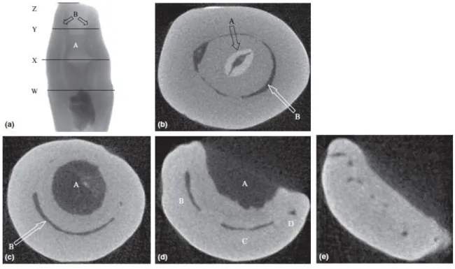 Figure  9 :  Différentes  coupes  tomodensitométriques  à  différentes  zones  d’une  dent  avulsée  de  classification IIIb selon Oehlers (7) .