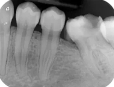 Figure 10 : Radiographie rétro alvéolaire secteur 3 avec présence de tartre en mésial de 37 