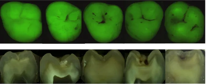 Fig. 6 Exemples d'images obtenues par QLF (26) correspondant aux  stades 0 à 4 de la classification ICDAS