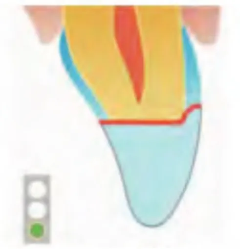Figure 8 : La préparation cavitaire de la dent.(8) 