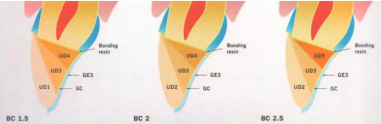 Figure 13 : Réalisation du corps dentinaire(8) 