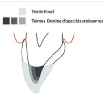 Figure 18 : Technique de stratification selon Vanini avec un email HRI ® (27) 