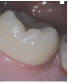 Figure 6 : Photos intra-buccales mode daylight (à gauche) et mode pério (à droite). Mise en évidence d'une  inflammation gingivale et de la présence de plaque dentaire [7]