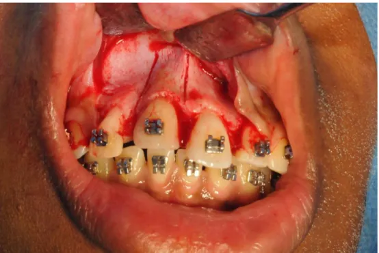 Figure 8c : Piézocision verticale en distal et en mésial (courtoisie R. Castro) 