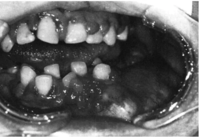 Figure 8 : Vue intra orale d’une tuméfaction mandibulaire gauche. 