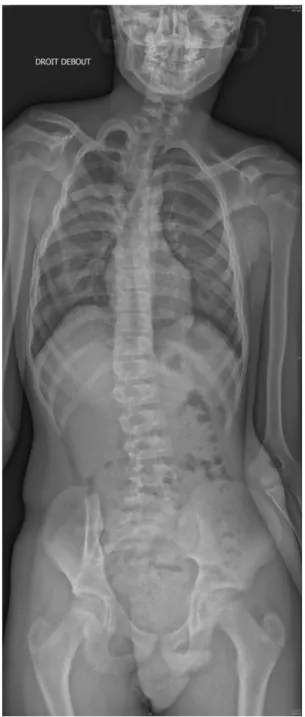 Figure III : Radiographie squelette axial objectivant une scoliose et une surélévation congénitale  de l’omoplate droite (déformation de Sprengel)