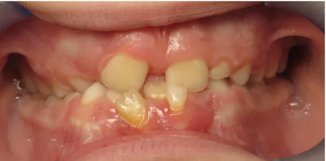 Figure V : Malocclusion de classe I à tendance classe III par brachygnathie maxillaire