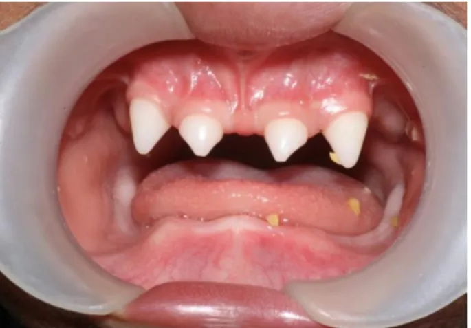 Figure N°11 : Dents conoïdes chez un patient présentant une dysplasie  ectodermique anhidrotique [45] 