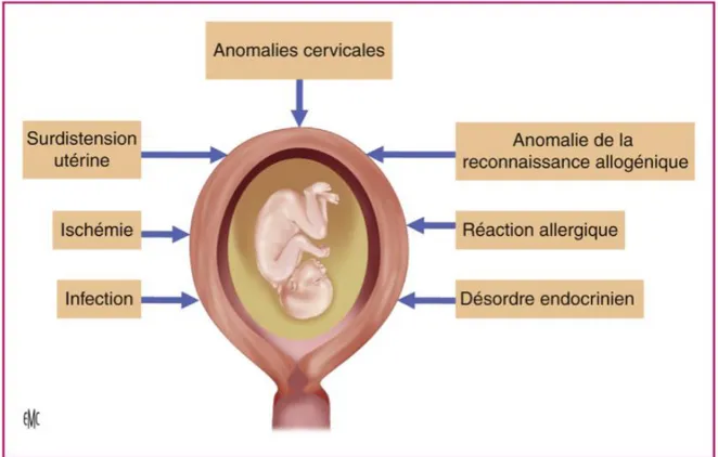 Fig. 1 : Étiologies du syndrome d’accouchement prématuré (20) 