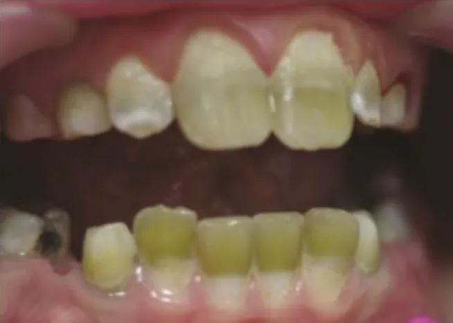 Fig. 4 : Pigmentation verte touchant les incisives centrales et latérales permanentes   maxillaires et mandibulaires