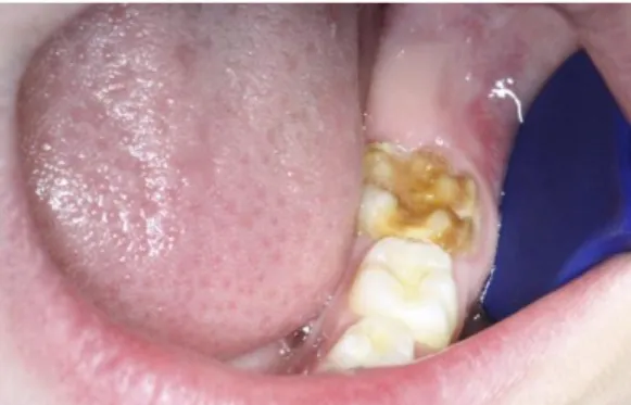 Fig. 6 : Défaut de développement de l’émail affectant la première molaire permanente  mandibulaire gauche  (50) 