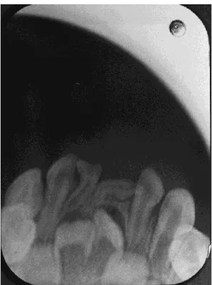 Fig. 8 : Radiographie péri-apicale montrant l’anomalie de la couronne dentaire et  l’absence de pénétration de l’incisive centrale temporaire mandibulaire gauche  (50) 