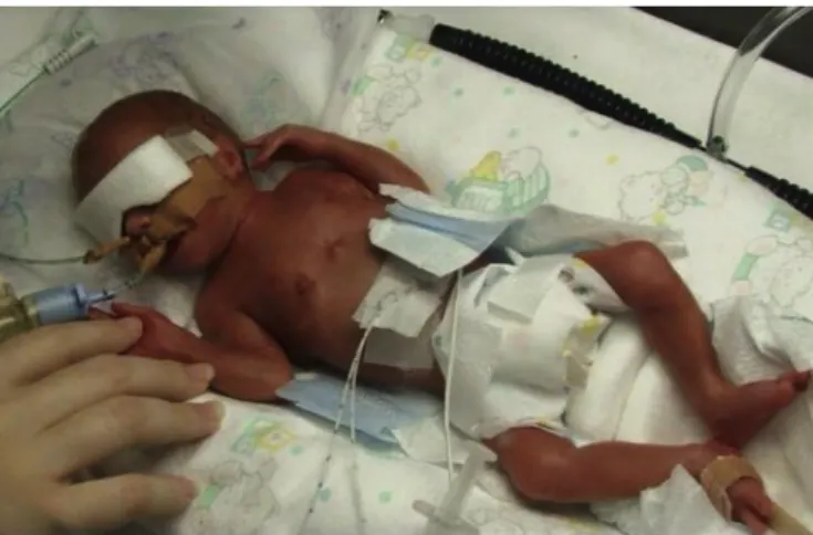 Fig. 9 : Enfant prématuré né à 25 semaines avec intubation orale  (50) . 