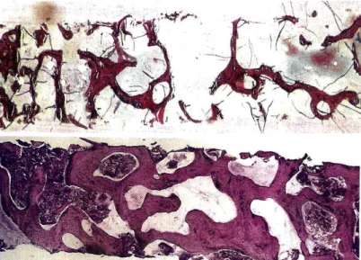 Figure 8 : Coupes histologiques de biopsies de site greffés avec de l’os autogène d’origine  iliaque après 4 mois et 2 ans de cicatrisation [9] 