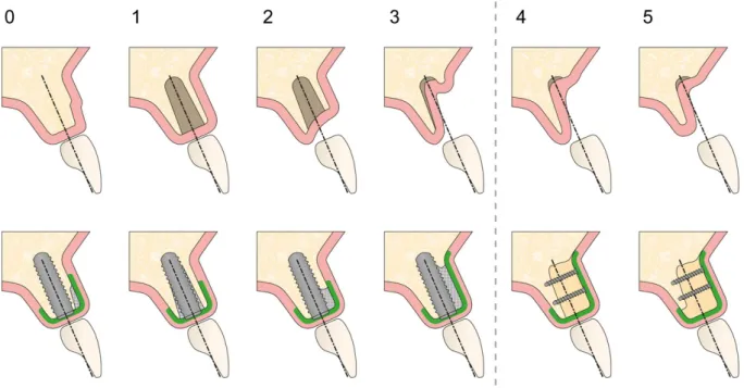 Figure 13 : Schéma présentant les classes de défauts osseux de 0 à 5 et les procédures  d'augmentation osseuse correspondantes [119] 