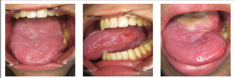 Figure 13 : Homme de 24 ans sans antécédents médicaux. Consulte à la demande de son  ORL pour des lésions linguales