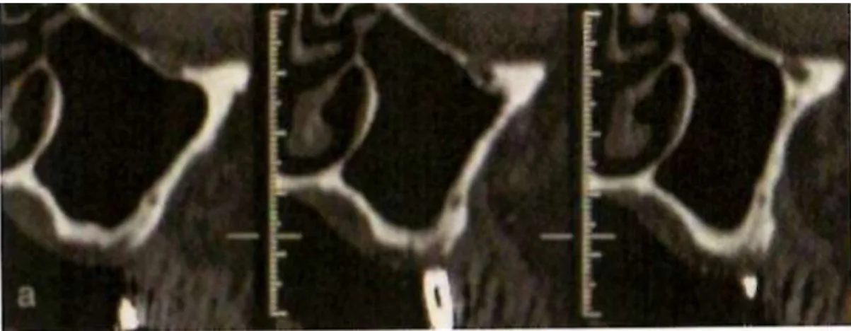 Figure 17 : Scanner montrant dans le secteur inférieur du mur antérieur du maxillaire, une  image radio-claire de 2-3 mm de diamètre correspondant à l’artère alvéolo-antrale