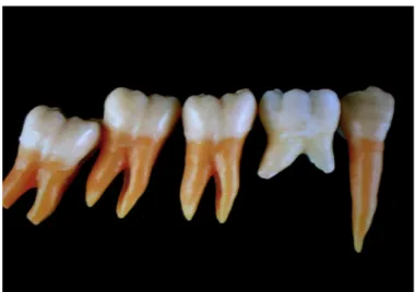 Fig 2 : Cas clinique. Traitement d’agénésie de prémolaires mandibulaires par des troisièmes  molaires  immatures, Andreasen, 1994 (9) 