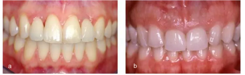 Figure 6 - a. Exemple de parodonte fin et festonné. b. Exemple de pardonte plat et épais (9)