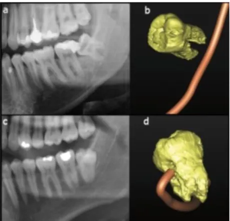 Figure 1 : Images de deux troisièmes molaires sur l’OPT et le CBCT  [11].