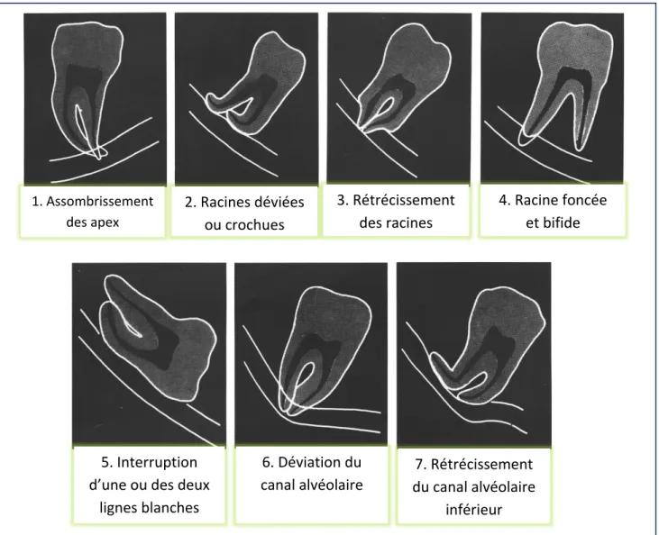 Figure 2 : Sept signes radiologiques de la classification de Rood et Shehab  [4].