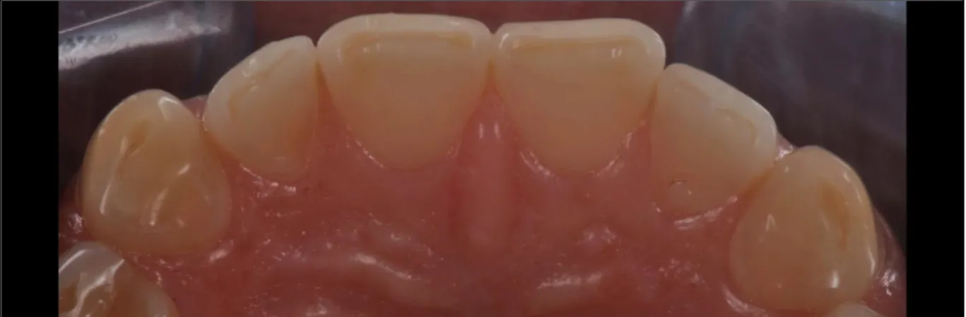 Figure 50 : vue des faces palatines des dents antérieures : on constate une perte importante de  l’émail palatin – Koubi S