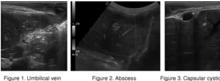 Fig. 2. Three-dimensional CT volume reconstruction illustrating extensive bone reaction in left mandible.