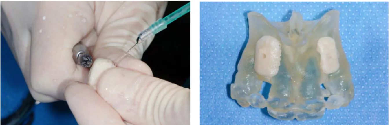 Figure 7 : remodelage du greffon à la fraise chirurgicale  Figure 8 : greffons personnalisés sur modèle  stéréolithographique 