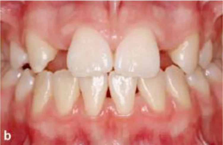 Figure 3 : ouverture des espaces orthodontiques en fonction de la place nécessaire                             pour une incisive latérale (idem) 