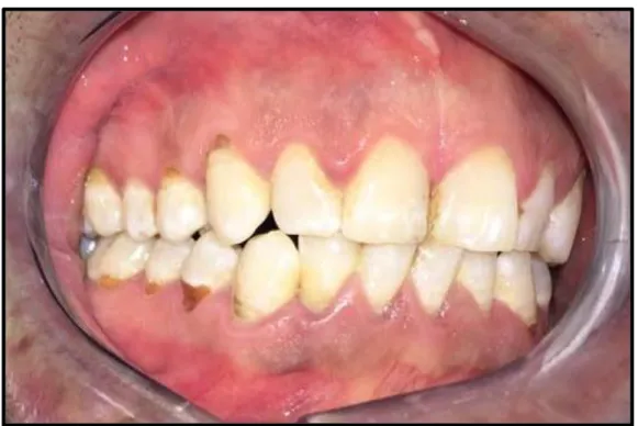 Fig. 5 : Erosions dentaires caractéristiques chez un fumeur quotidien de cannabis  (Photographie de Romain CASTRO) 