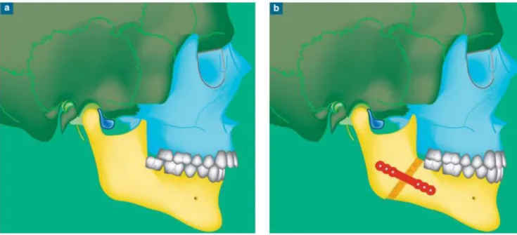Figure 1 a-b : Si la position du disque est instable lors du positionnement des arcades dentaires  en  bonne  occlusion,  le  disque  est  mal  positionné