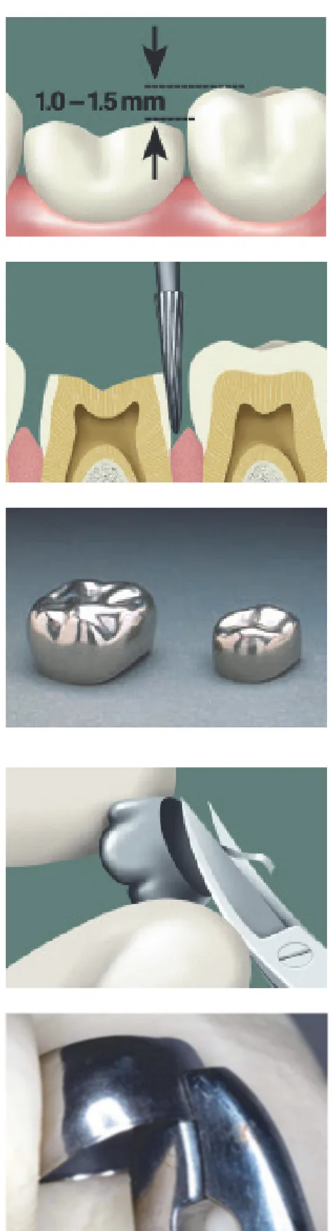 Figure 1. Réduction de la face  occlusale d’environ 1,0 à 1,5mm. 