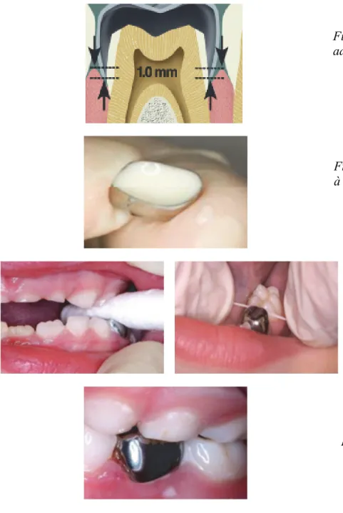 Figure 6. Essayage de la coiffe, et  adaptation intra-sulculaire. 